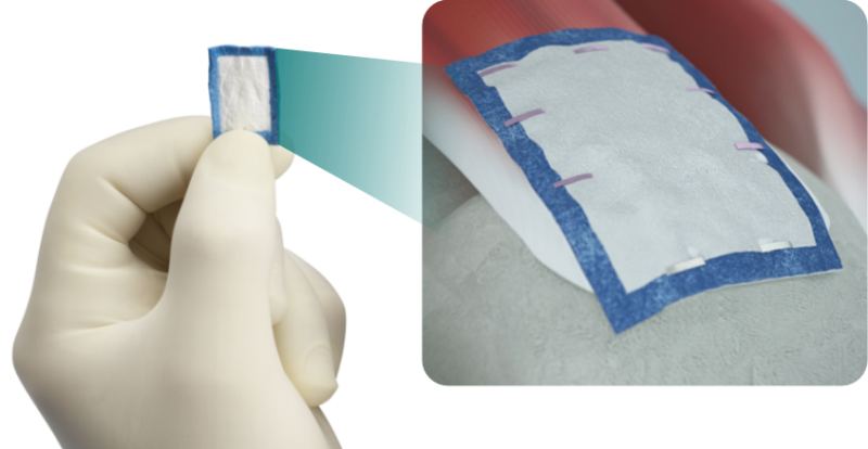 Regeneten Bioinductive Implant - Wisconsin Bone and Joint, SC