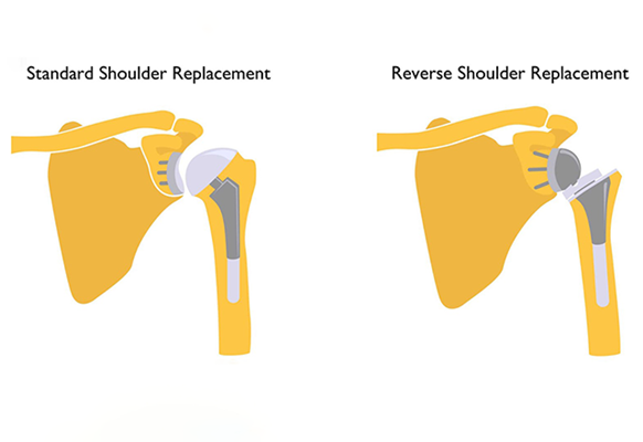 Reverse Total Shoulder Replacement Surgery 
