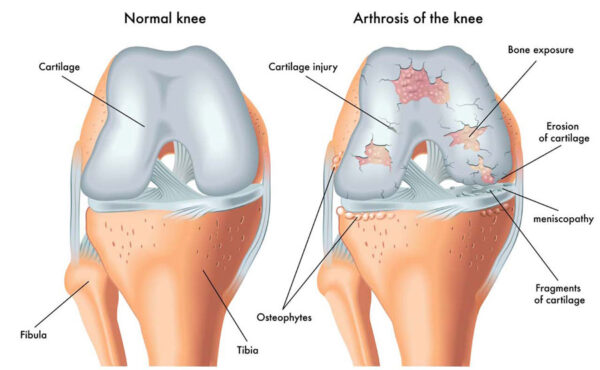 Osteoarthritis Posterior Total Hip Replacement 