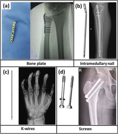 hand Fractures in Milwaukee WI