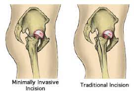 minimally invasive hip surgery
