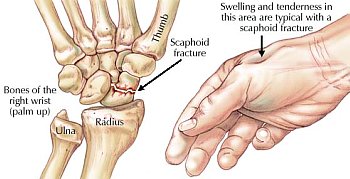 Wrist Fracture Surgery in milwaukee WI