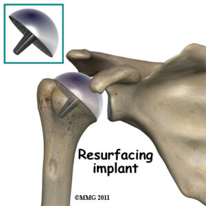 What is Shoulder Resurfacing Surgery? Surgeons at Milwaukee, WI