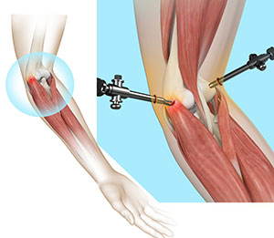 Elbow Surgery