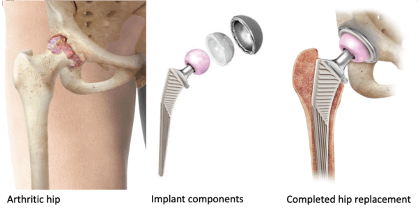 Total Hip Replacement Posterior Total Hip Replacement